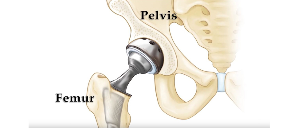 Hip replacement